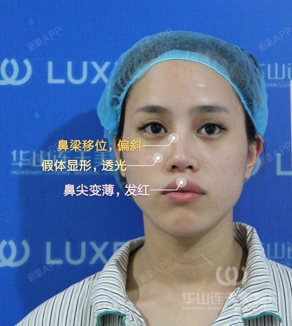 【案例解析】为什么鼻尖不能放假体!