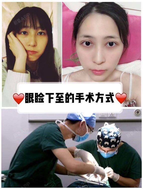 眼睑下至的手术方式