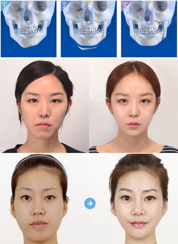 如果面部不对称现象较明显,面部中心线不吻合,可以通过双鄂手术进行