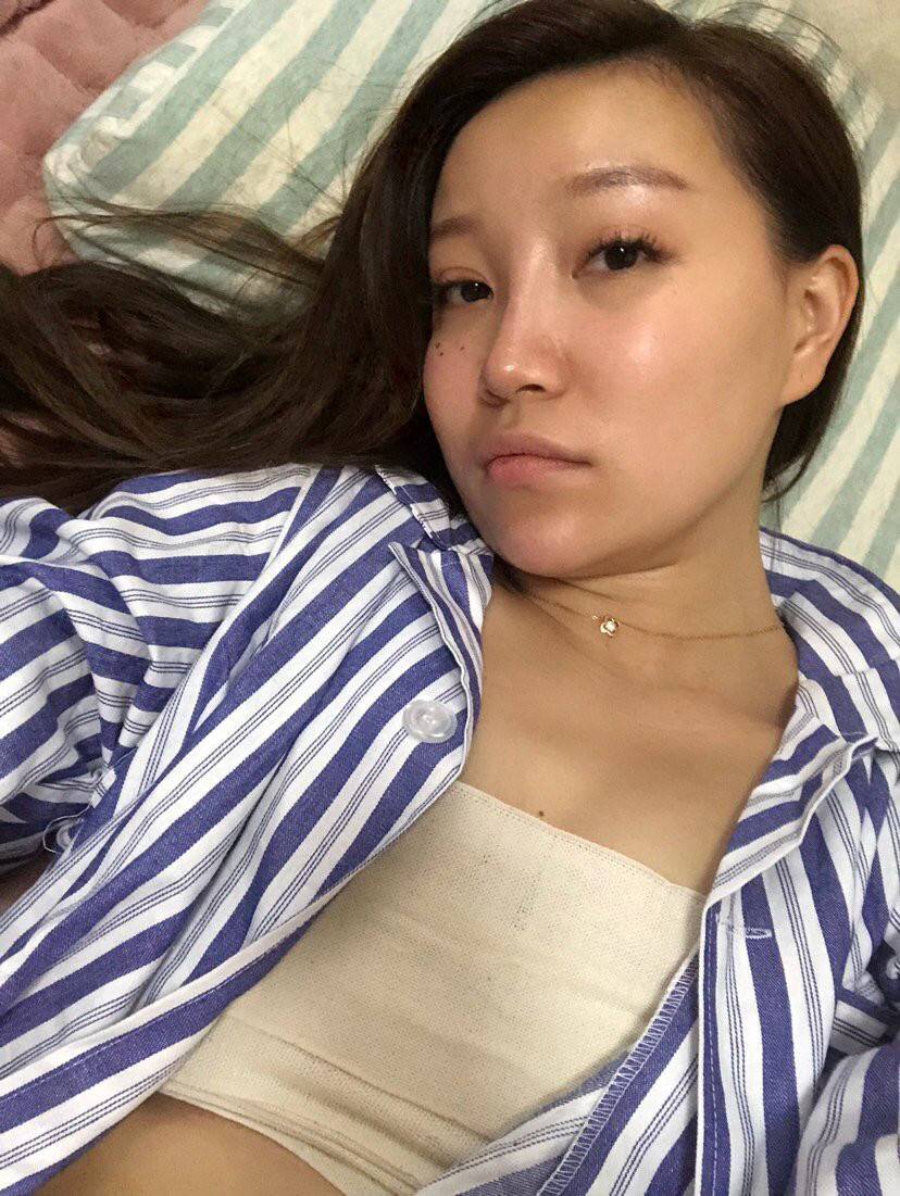 自体脂肪隆胸第1天