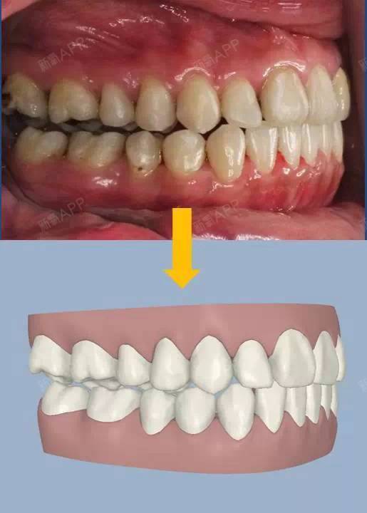 首先经由先进的3d电脑雷射扫描技术将实体的牙齿转换成3d数码模型.
