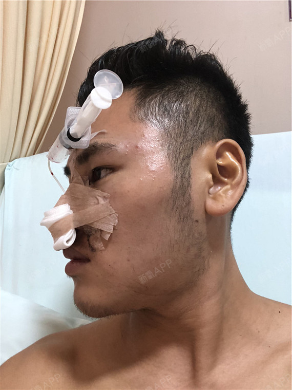 宽鼻矫正 | 术后当自强 | 鼻骨矫正 | 重庆同城 | 手术缩鼻头 | 鼻