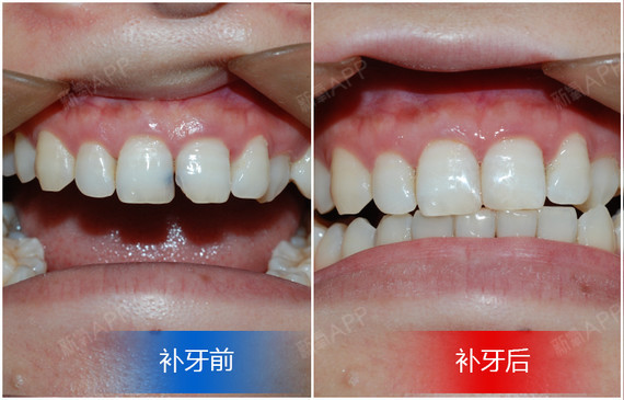 【用树脂材料填充的补牙可以保持多久?】补牙