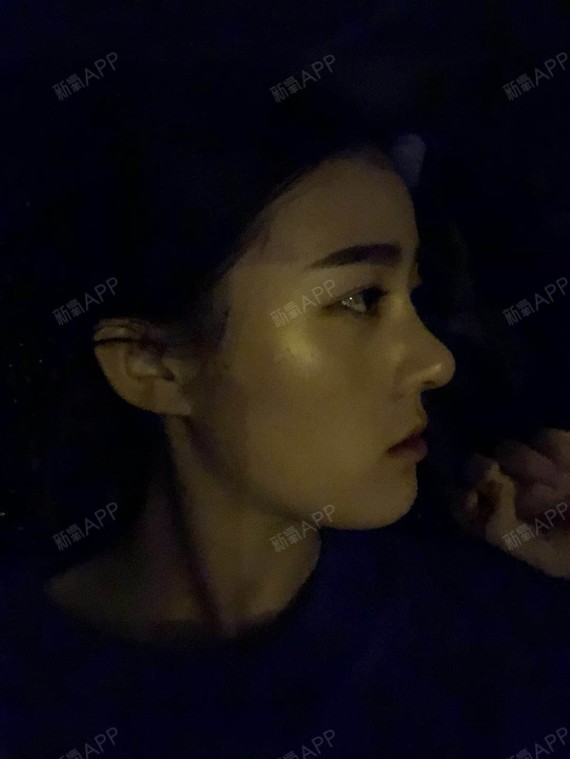 氧气x7lcn肋软骨隆鼻第30天美丽日记