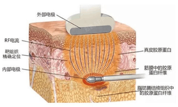 面部吸脂专治瘦脸针解决不了的脂肪脸拥有一张