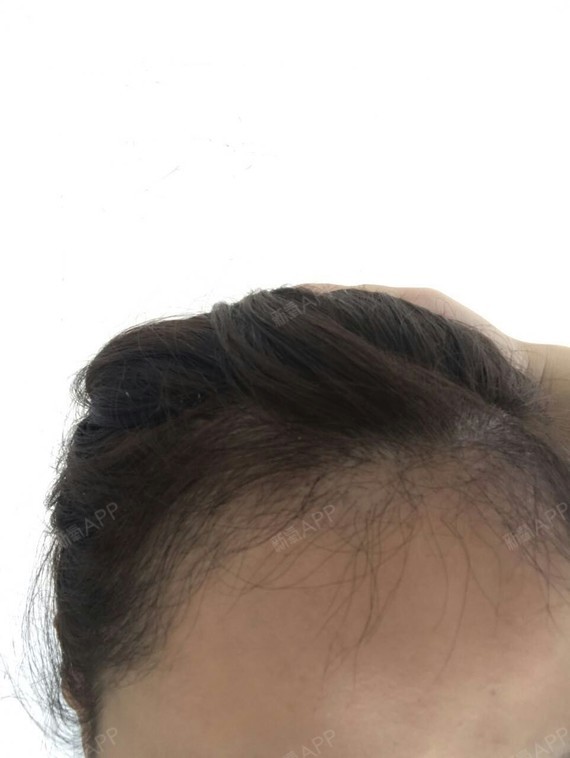 总怕头发就不长出来了,后来慢慢看见小发茬才安心下来,现在长度三厘米