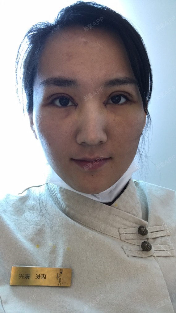 北京切开双眼皮好不好_效果图_xing兴切开双眼皮术后4
