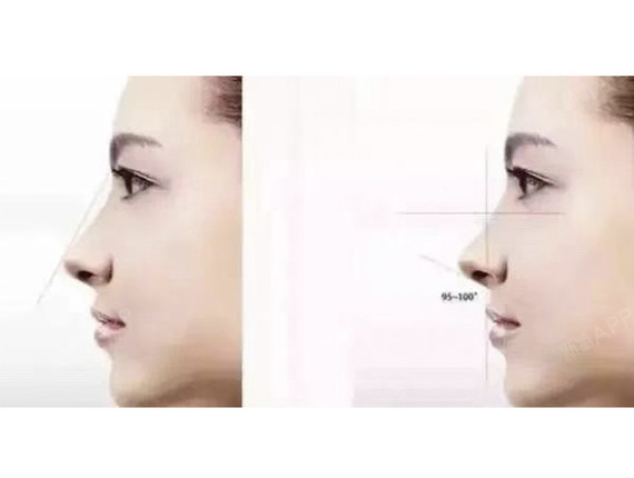 东方人的美鼻标准  医学上有一个"三点一线"的美学概念,所谓"三点