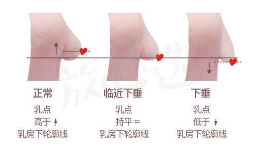 生完孩子胸部下垂的厉害?应该如何修复?生孩子是一件幸福的事~怀胎十月之后_圈子-新氧美容整形