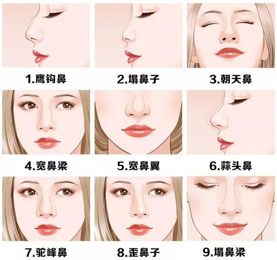 比较常见需要改善的鼻型有哪些?