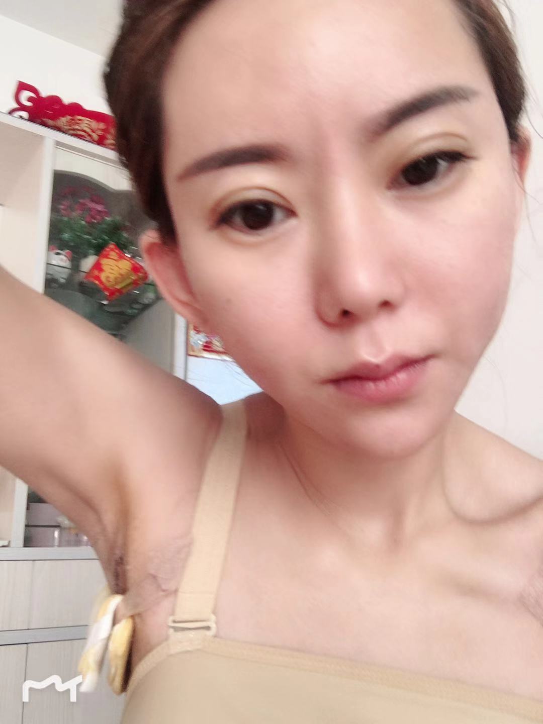 假体隆胸第7天