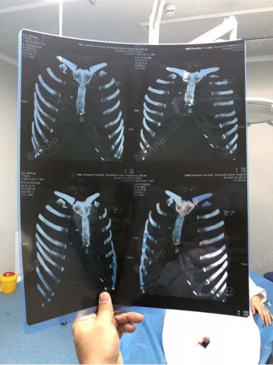 鼻基底,鼻小柱移植物用来解决鼻基底凹陷 手