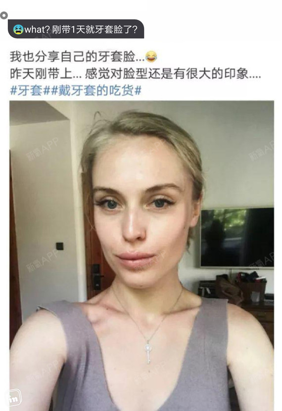 07牙套脸究竟是什么样子?03是牙性_圈子-新氧美容整形