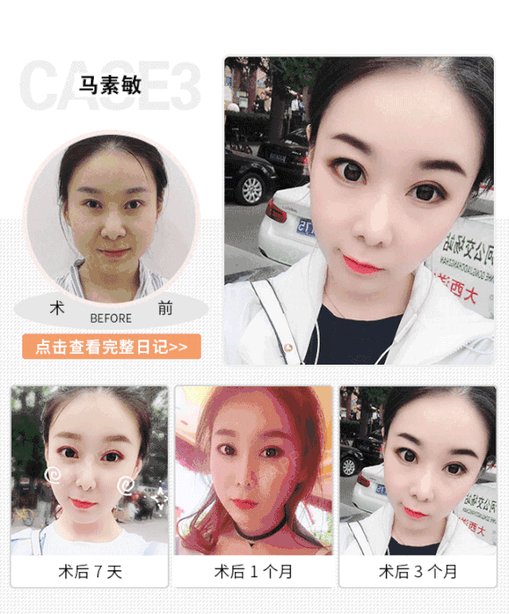 【下眼下至术】眼睑下至 放大双眼 无辜萌系 秒变女神