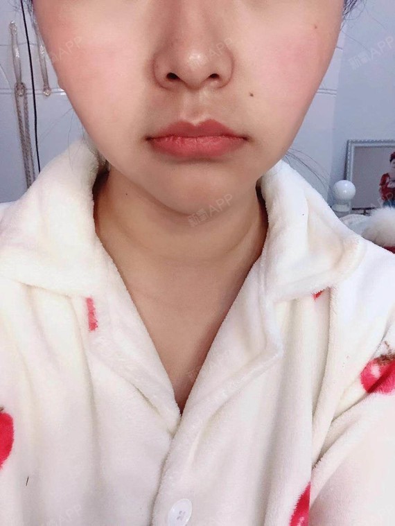 取颊脂垫瘦脸好不好_效果图_我很靓取颊脂垫瘦脸术后