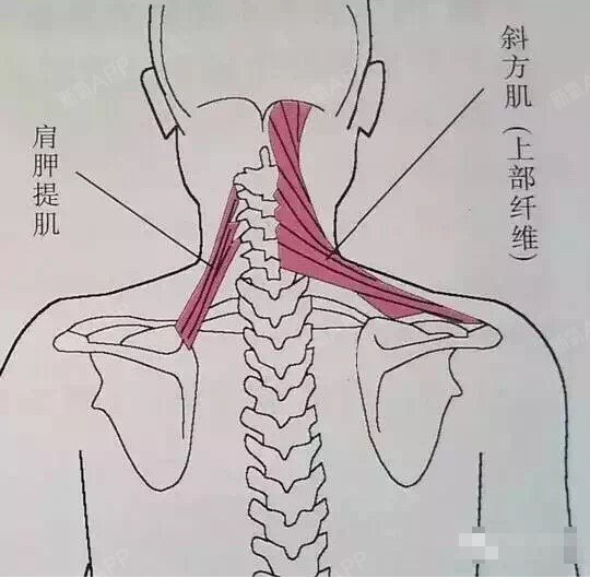 颈背部酸痛的美容科选择——瘦肩针!