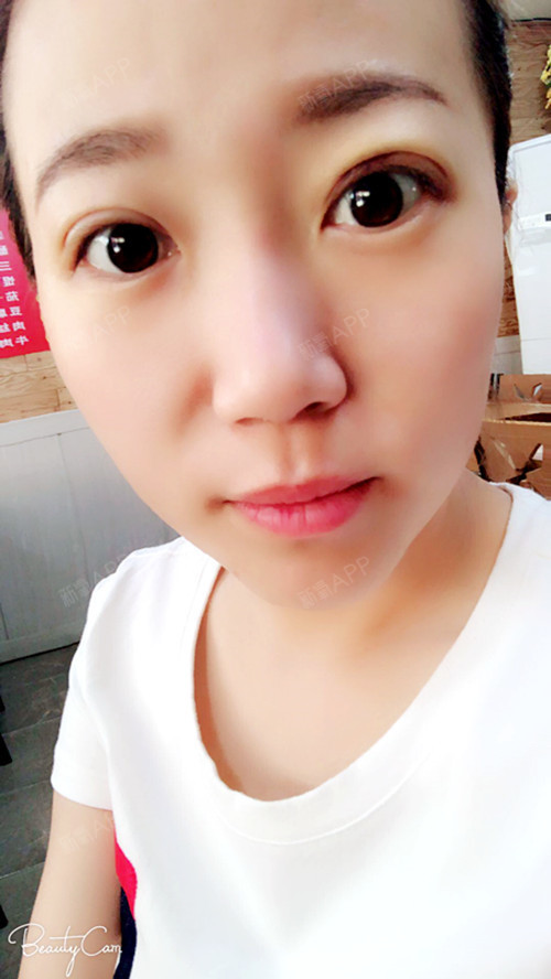 魅力的大眼睛埋线双眼皮第0天美丽日记-新氧美