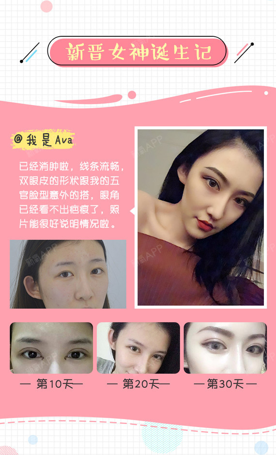 【定点双眼皮】韩式三点双眼皮 限时抢约 多点定位