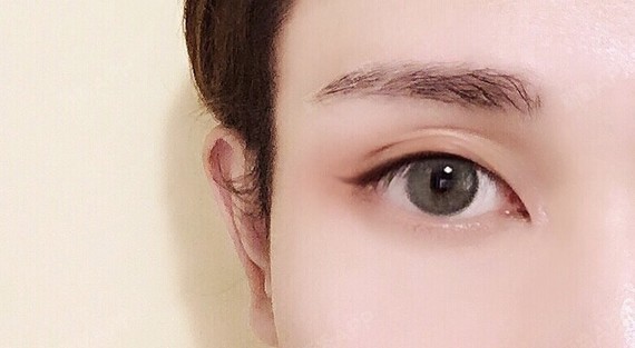 玻尿酸除皱纹和眼角纹,效果如何要知道在当前