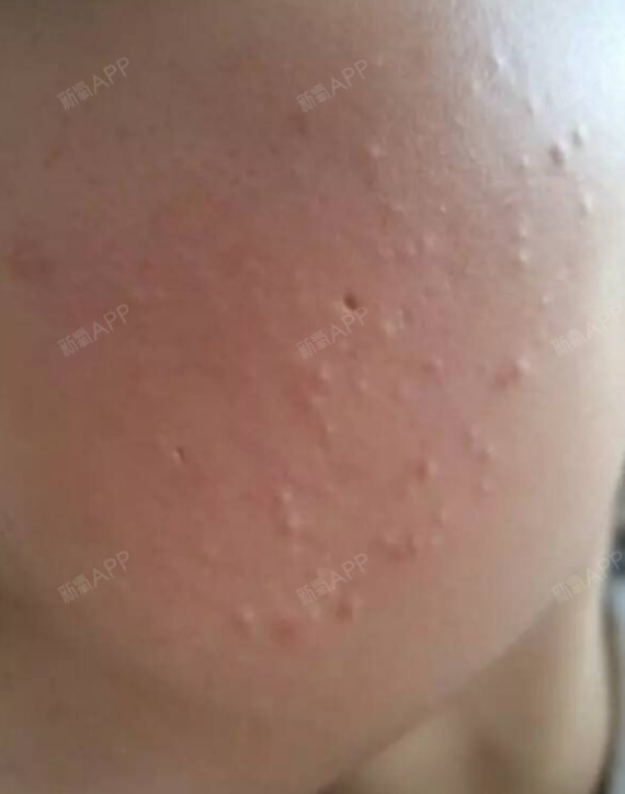 闭合性粉刺形成原因痘痘、痤疮、粉刺、疖肿、