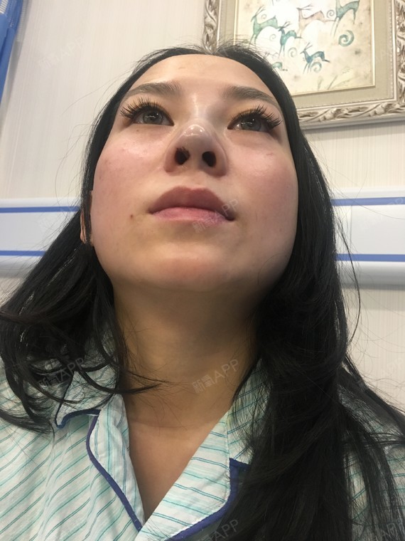 鼻骨矫正|鼻部修复|重庆同城|手术缩鼻翼|鼻小柱|手术