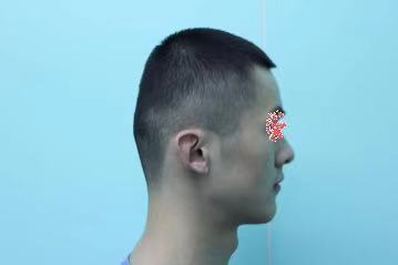 因为小时候睡觉没睡好导致后脑勺扁平,之前一直想做,但是由于国内做