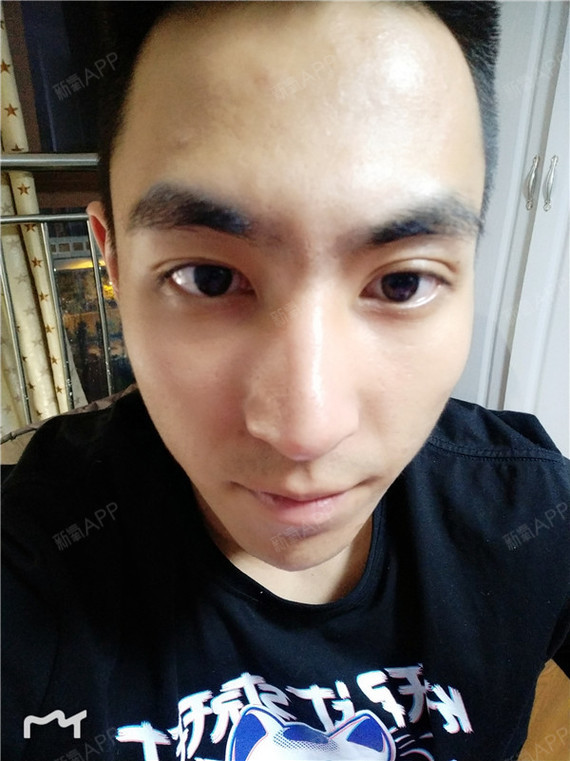 鼻部多项好不好_效果图_我是你的男盆友鼻部多项术后