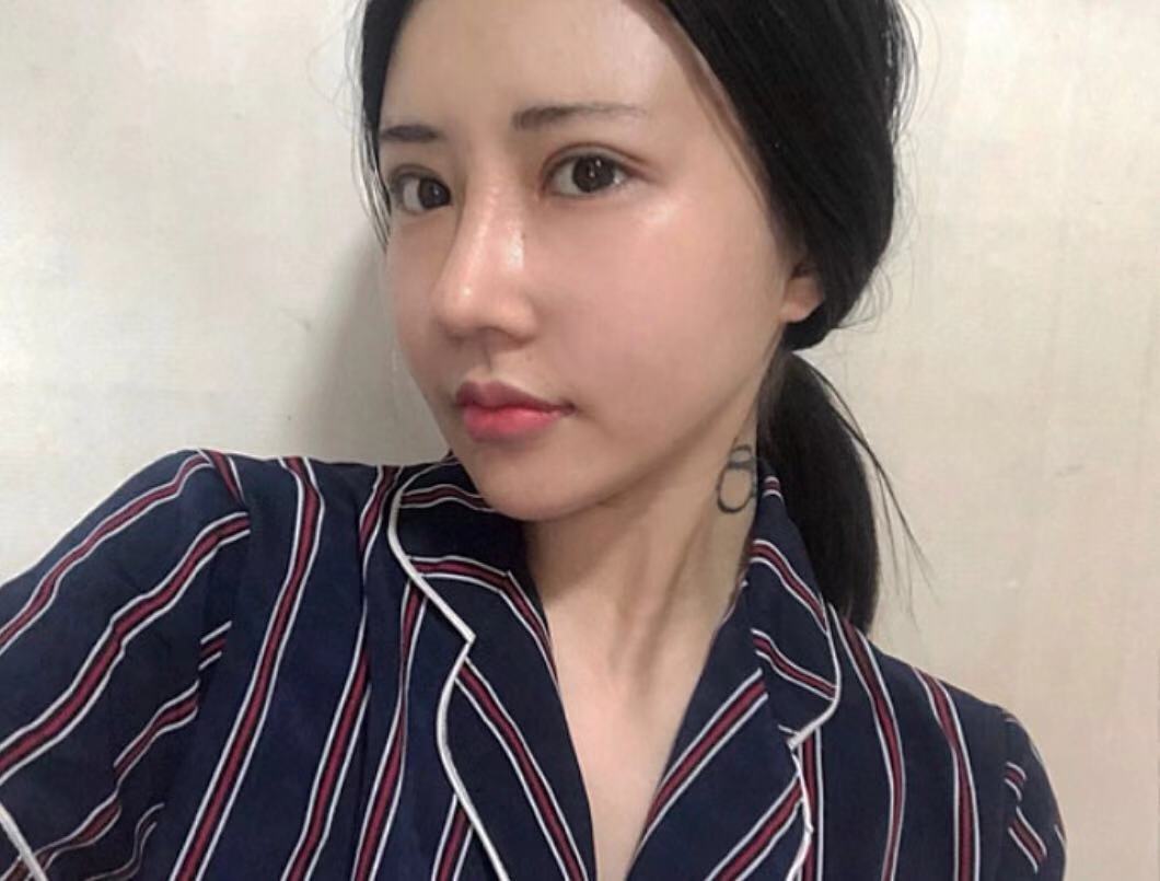 耳软骨复合隆鼻第26天