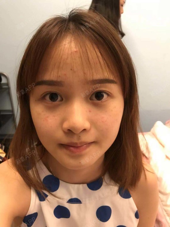 双眼皮埋线一定比切开更容易塌掉吗?