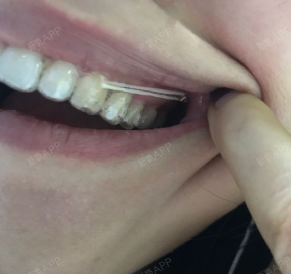 想做牙齿隐形矫正,这些你必须了解很多人在做