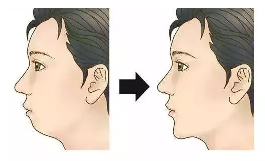 这5种牙齿矫正后,脸型变化最大!1、地包天-易形