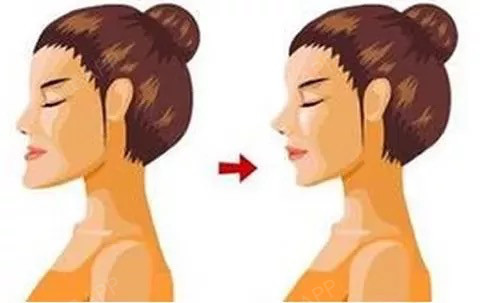 这5种牙齿矫正后,脸型变化最大!1、地包天-易形