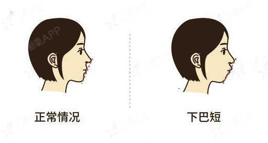 这5种牙齿矫正后,脸型变化最大!1、地包_圈子