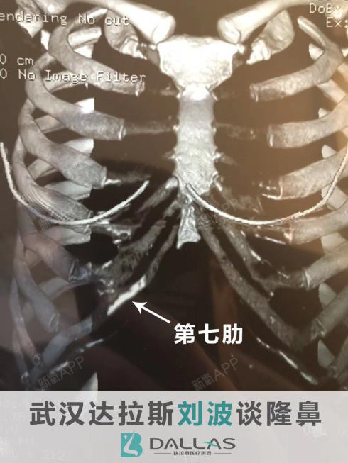 肋软骨钙化了还能做鼻子