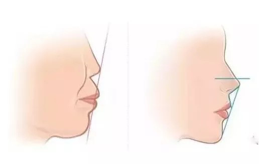 这5种牙齿矫正后,脸型变化最大!1、地包天-易形