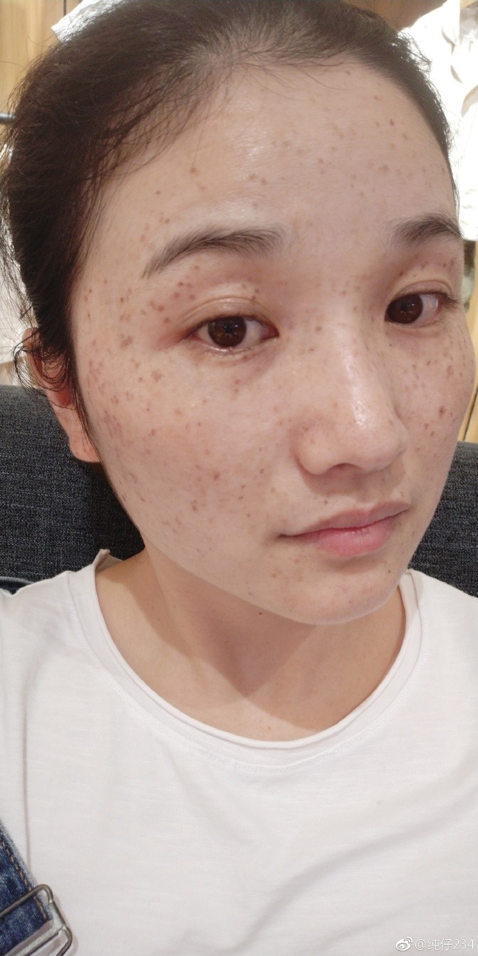 今天是超皮秒祛斑的第三天,有斑的地方颜色更深了,有的地方痂还翘皮