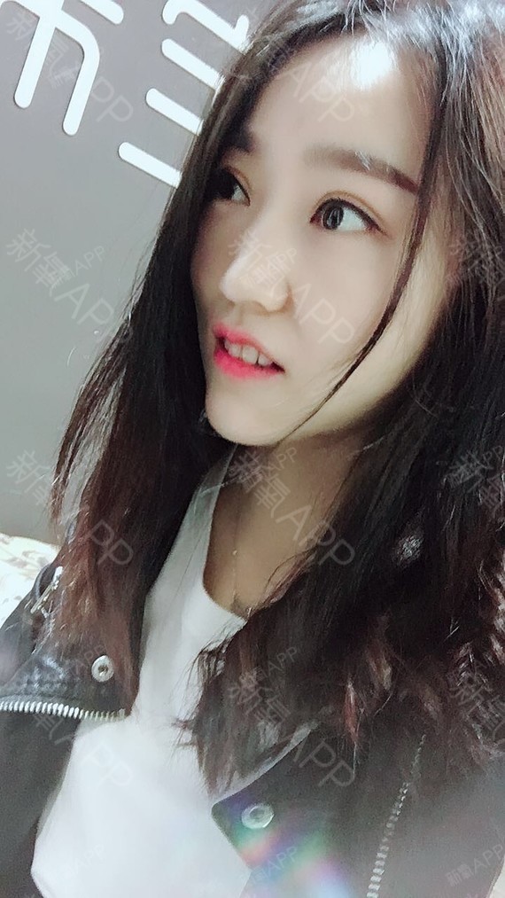 与你素手挽清风面部吸脂第21天美丽日记-新氧