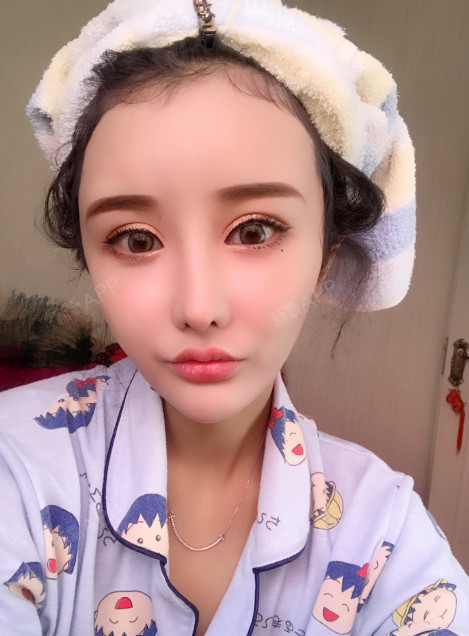 阿紫姑娘肋软骨隆鼻术后第259天美丽日记_新氧整形