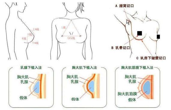假体丰胸是一种非常不错的丰胸手术,它是通过在女性的腋窝,乳晕,乳房