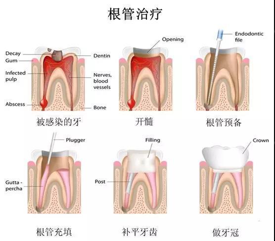 通过清除根管内的炎症牙髓和坏死物质,并进行适当消毒,充填根管,以