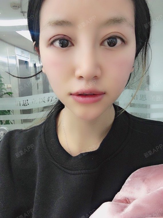 氧气htu534a厚唇改薄术后第7天美丽日记_新氧整形