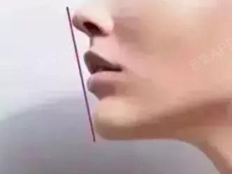 很多小姐姐就疑惑了 那我是要注射还是假体呢 ▼▼▼ 注射丰下巴 可以