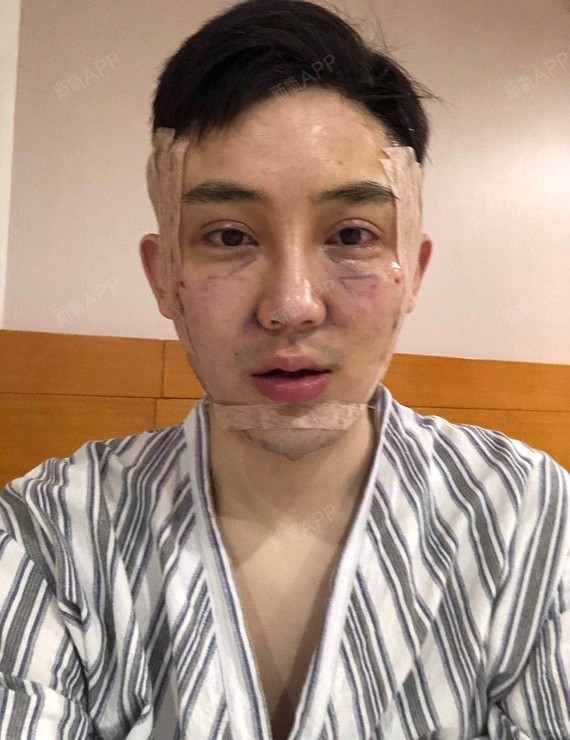 面部吸脂