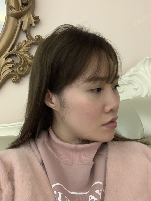 觉得自己的鼻子太难看了,一点立体感都没有,显得我很_圈子-新氧美容