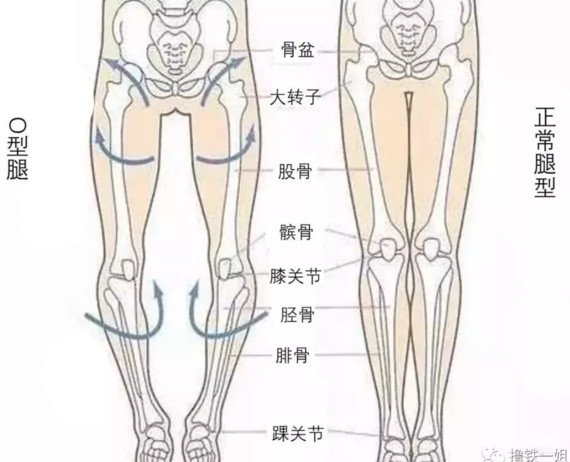 股骨外旋(大腿骨):那么自然大腿外侧会显得粗壮 胫骨内旋(小腿骨)