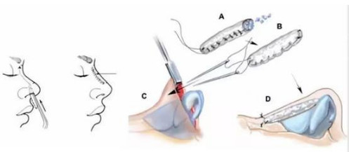 取肋软骨隆鼻很恐怖?那你一定要看这篇最近,有小仙女留言说,非常想知道一些_圈子-新氧美容整形