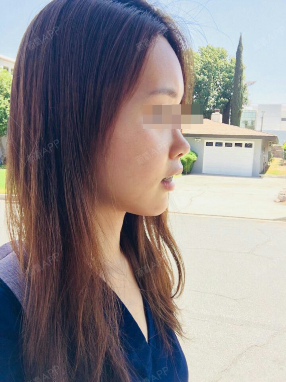 新氧- 雾中中行行不断 | 面部轮廓 | 上下颚 | 术后当自强 | 广州同城