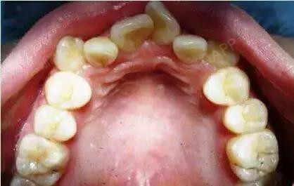 01小孩口腔有不良习惯牙齿 牙齿畸形除了有遗传的因素外,后天的影响
