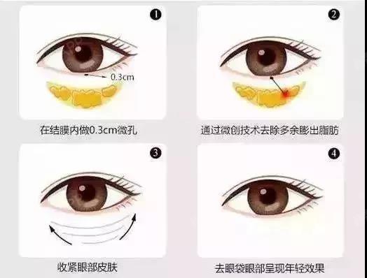 真人案例|35岁大叔去眼袋全过程，术后年轻10岁[:79]自从过了25岁_圈子-新氧美容整形