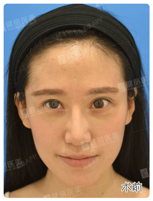 还有社长家的年女士 术前的她颧骨凸出,额头扁平 苹果肌十分干瘪 与